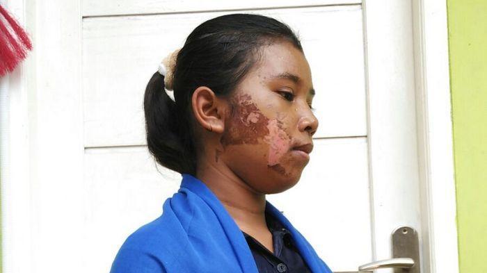 Keliru Membeli Makanan, Seorang Pembantu di Koja Disetrika Wajahnya oleh Majikan