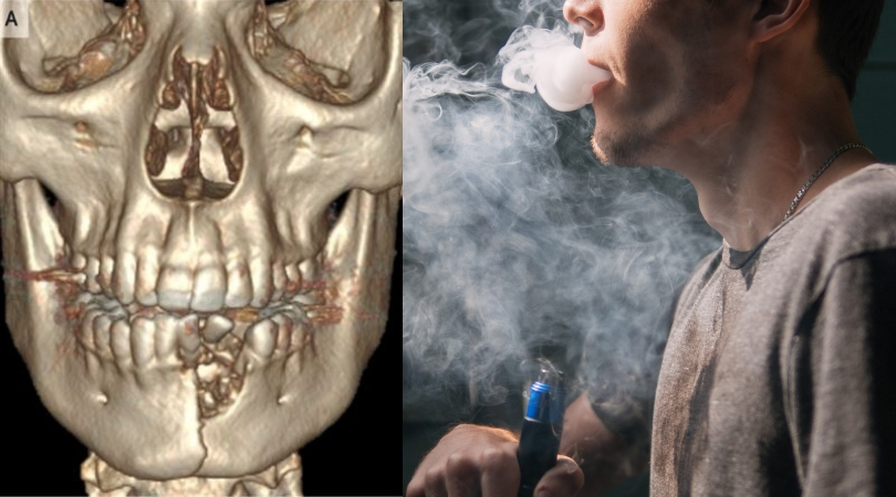 Waduh, Vape Makan Banyak Korban Lagi Gan !