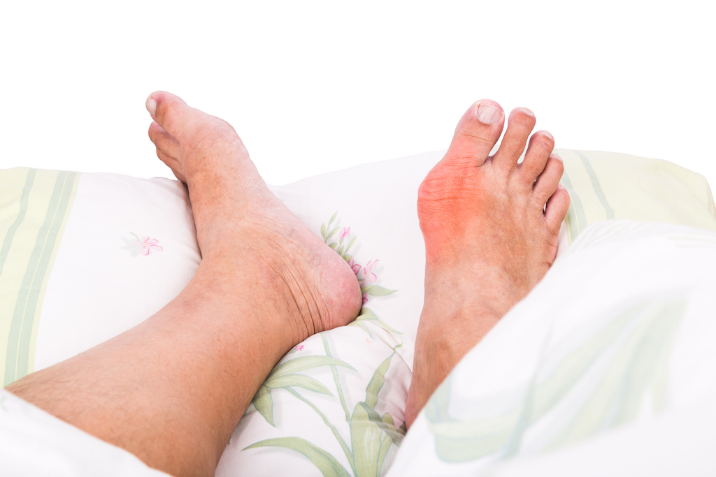 6-gejala-asam-urat-pada-kaki-yang-tidak-boleh-diremehkan