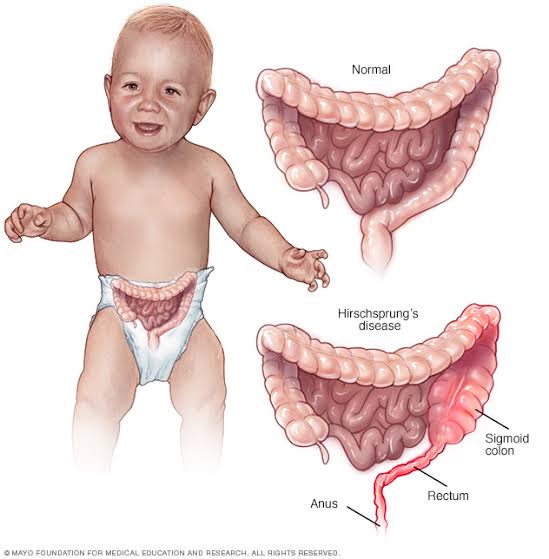 Duh! Berikut Ini Penyakit Langka Yang Menyerang Bayi Baru Lahir. Kenali Gejalanya