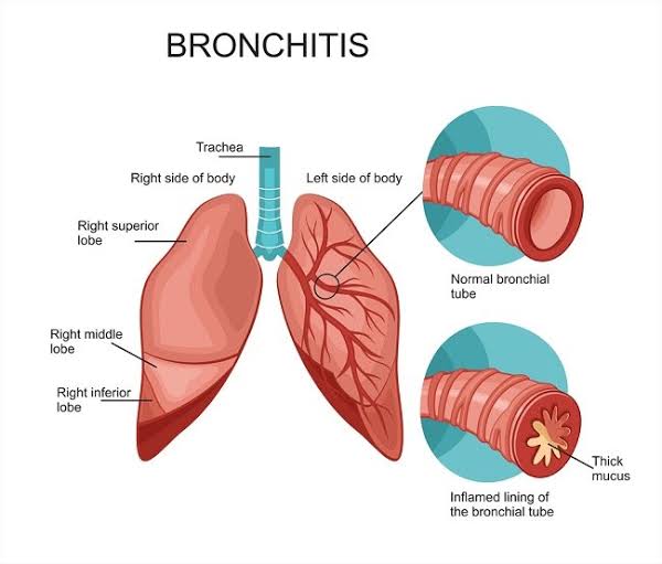 Hati-Hati Perokok Pasif, Bayi Ini Terkena Bronkitis Akibat Asap Rokok Ayahnya