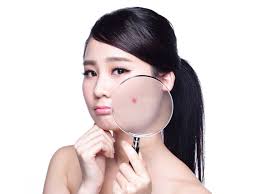 tips Sipoteng (cara ampuh menghilangkan jerawat)