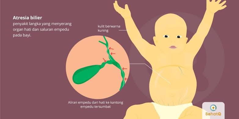 Duh! Berikut Ini Penyakit Langka Yang Menyerang Bayi Baru Lahir. Kenali Gejalanya