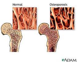 kenapa-wanita-rentan-terkena-osteoporosis-cwo-jg-bole-masuk-sekedar-share-ilmu