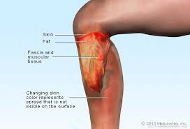 Necrotizing Fasciitis, Ganasnya Bakteri Pemangsa Daging Manusia