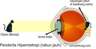 Ternyata Wortel Tidak Bisa Menyembuhkan Minus!!
