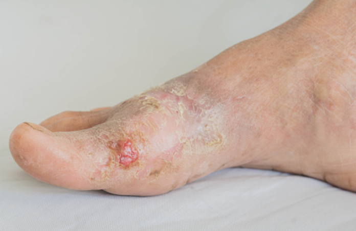 ciri-ciri-penyakit-gula-pada-kaki-mengenali-gejala-dan-pencegahannya