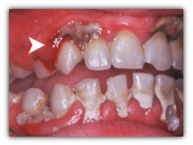 Ketika Karang Gigi Tak Kunjung Dibersihkan, Ini yang Terjadi