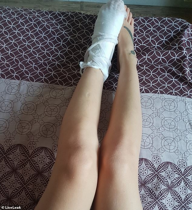 Bodoh Ga Ketulungan, Kaki Cewek Ini Luka Gara-gara Loncat Ke Danau Yang Membeku