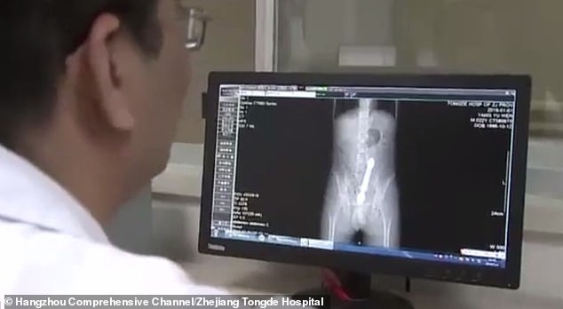 Man has a 10in long rod stuck in his bowels after 'inserting it into his rear for