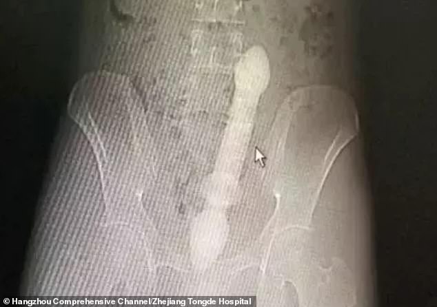 man-has-a-10in-long-rod-stuck-in-his-bowels-after--inserting-it-into-his-rear-for