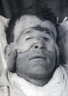 Orang Pertama yang Melakukan Operasi Plastik Di Dunia