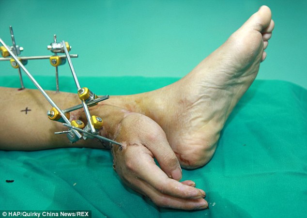 Dokter di China "Cangkok" Tangan di Kaki