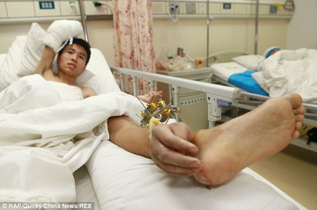 Dokter di China "Cangkok" Tangan di Kaki
