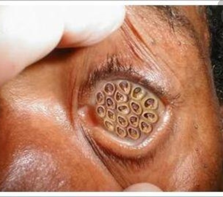 Trypophobia: Penyakit umum Tapi Menarik!! Pict+