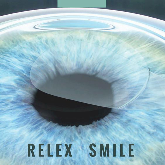 ReLEx SMILE, Solusi Mata HD yang Cocok Buat Millenials