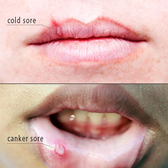 Benjolan di bibir dan mulut bukan cuma sariawan 〴⋋_⋌〵
