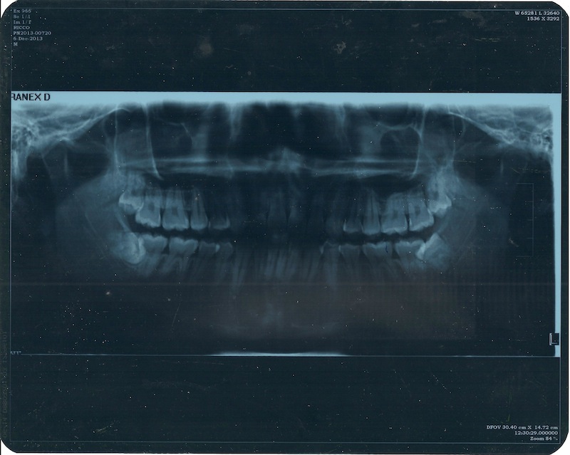&#91;SHARE&#93; Pengalaman Cabut Gigi Geraham Bungsu (Wisdom Teeth) Dengan BPJS di RSCM