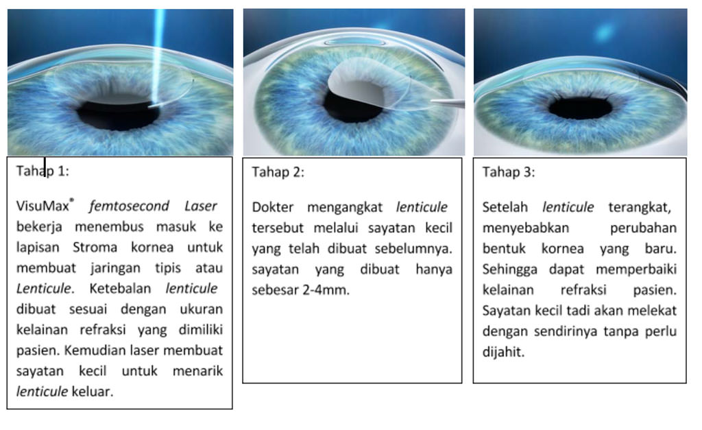 ReLEx SMILE, Solusi Mata HD yang Cocok Buat Millenials