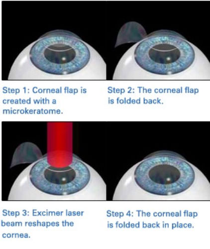 &#91;SHARE&#93; Pengalaman Ane operasi mata LASIK. Minus mata ane langsung ilang gan…