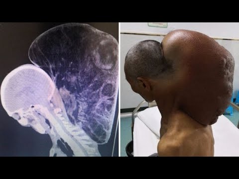 Seram! Pria Ini Memiliki Tumor Seberat 15 Kg di Leher Selama 47 Tahun