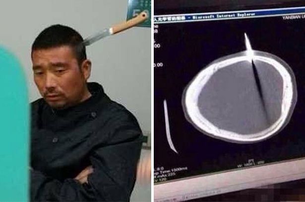 Lelaki China datangi rumah sakit dalam keadaan pisau tertancap di kepalanya