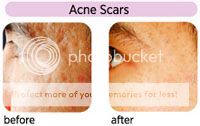 menghilangkan-acne-scar-bekas-jerawat