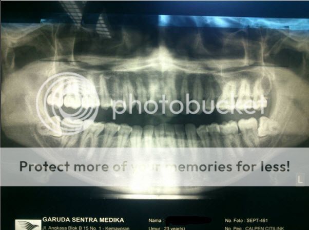 share-pengalaman-cabut-gigi-geraham-bungsu-wisdom-teeth-dengan-bpjs-di-rscm