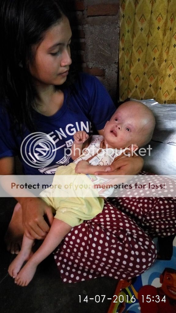 Rahman bayi 3 bulan penderita Hydrosepalus