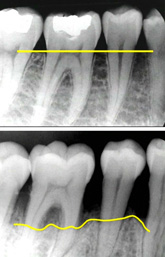 Mengenal Periodontal Desease. Hati2 gusinya sering berdarah!!!