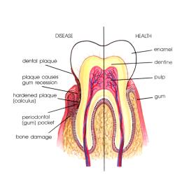 Mengenal Periodontal Desease. Hati2 gusinya sering berdarah!!!