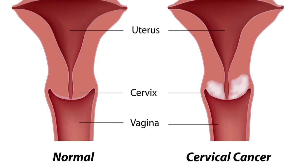 Waspada, Sis! Berikut Jenis Kanker yang Banyak Menyerang Perempuan!