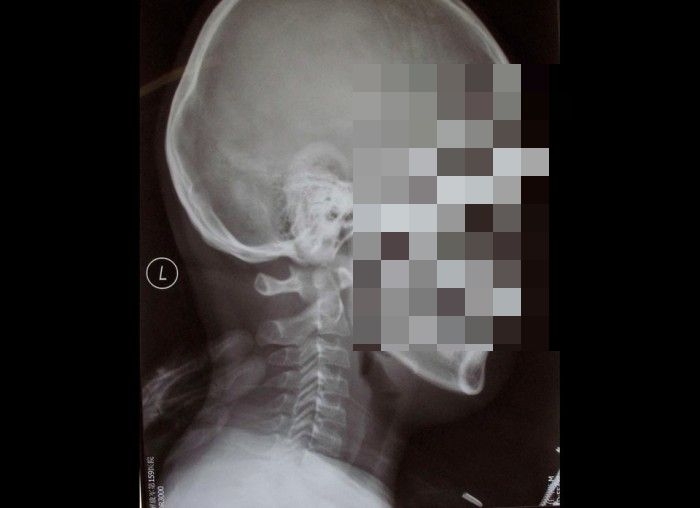 7 Benda Aneh Dalam Tubuh Yang Tertangkap Oleh Sinar X- Ray