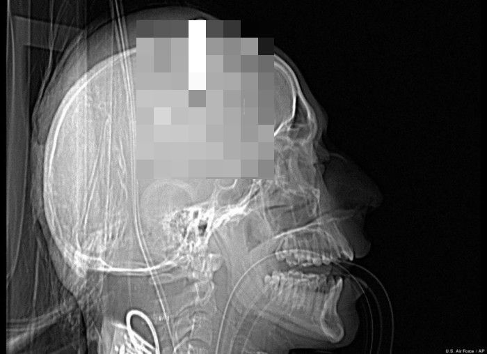 7 Benda Aneh Dalam Tubuh yang Tertangkap Oleh Sinar X- Ray ...