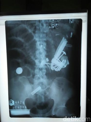 Asal Usul 52 Benda di Perut Hendro: Ditelan Satu Persatu