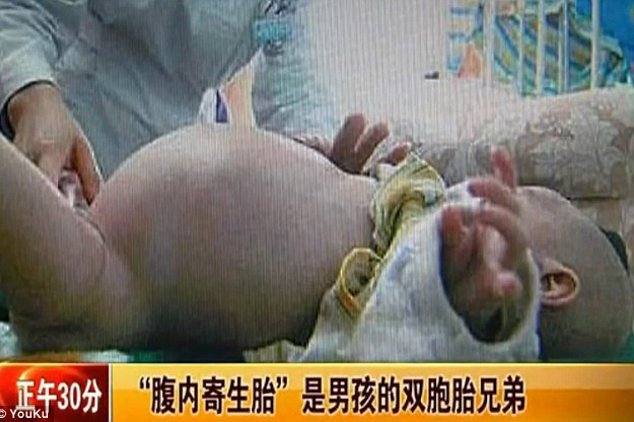 Xiao Feng, Balita Laki-laki yang "Hamil" Saudara Kembarnya Sendiri