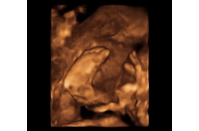 Bayi yang Sudah 'Lahir' Meski Masih di Kandungan