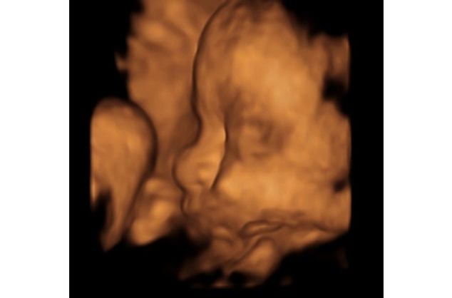 Bayi yang Sudah 'Lahir' Meski Masih di Kandungan