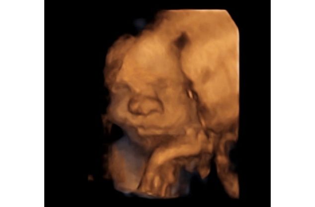 Bayi yang Sudah 'Lahir' Meski Masih di Kandungan
