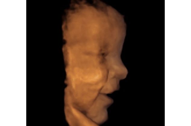 Bayi yang Sudah 'Lahir' Meski Masih di Kandungan
