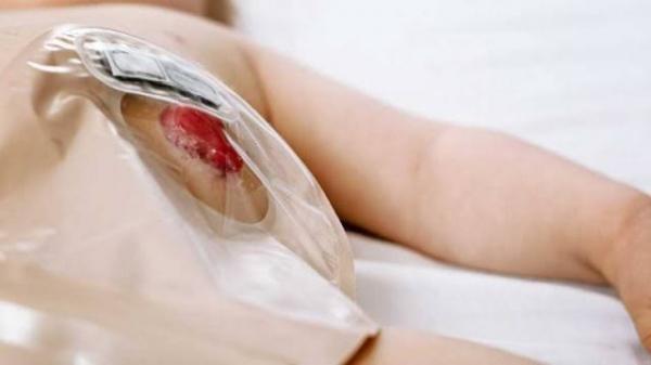 Biadab! Anus Robek 6 Sentimeter, Balita Korban Sodomi di Wanasalam Harus Lewat Perut