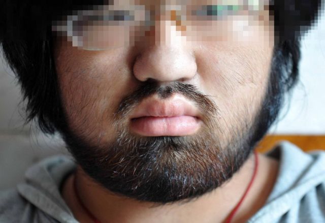 Aneh, Gadis Remaja Ini Wajahnya Ditumbuhi Jenggot