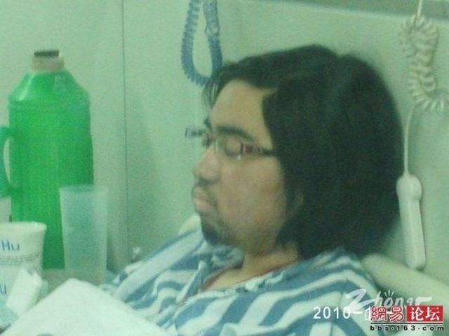 Aneh, Gadis Remaja Ini Wajahnya Ditumbuhi Jenggot