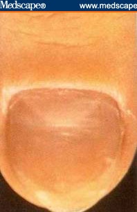 Yuk Perhatiin Kuku Kalian, Ada Dan Tidaknya Lunula, Bisa Jadi Alarm Kesehatan Kita
