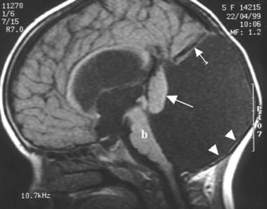 Dandy Walker Syndrome, Penyakit Sporadis yang Mengambil Adam Fabumi