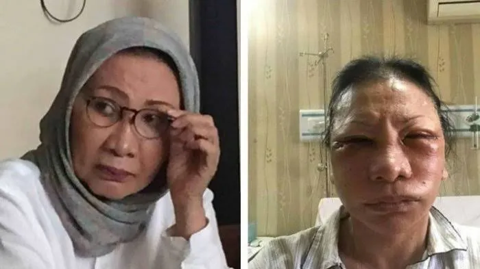 Tidak Disangka, Ternyata Ratna Sarumpaet Sudah Lakukan Operasi Plastik Sebanyak Ini