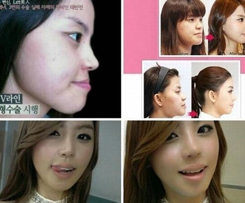 Operasi Plastik Korea, cewe jelek mulut serong muka serong menjadi cewe cantik!