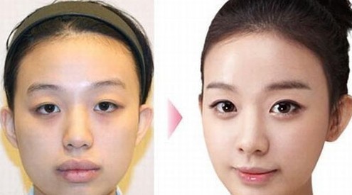 Operasi Plastik Korea, cewe jelek mulut serong muka serong menjadi cewe cantik!