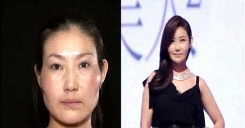 Operasi Plastik Korea, cewe jelek mulut serong muka serong menjadi cewe cantik!