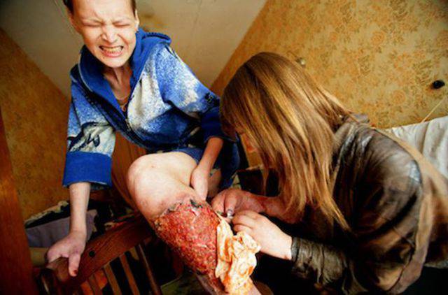 Krokodil buat manusia jadi zombie, lebih parah dari HIV/AIDS &#91;no hoakz&#93;